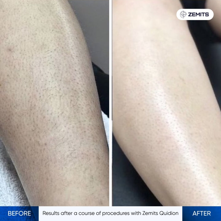 Zemits Quidion Laser Diode Pour L'épilation