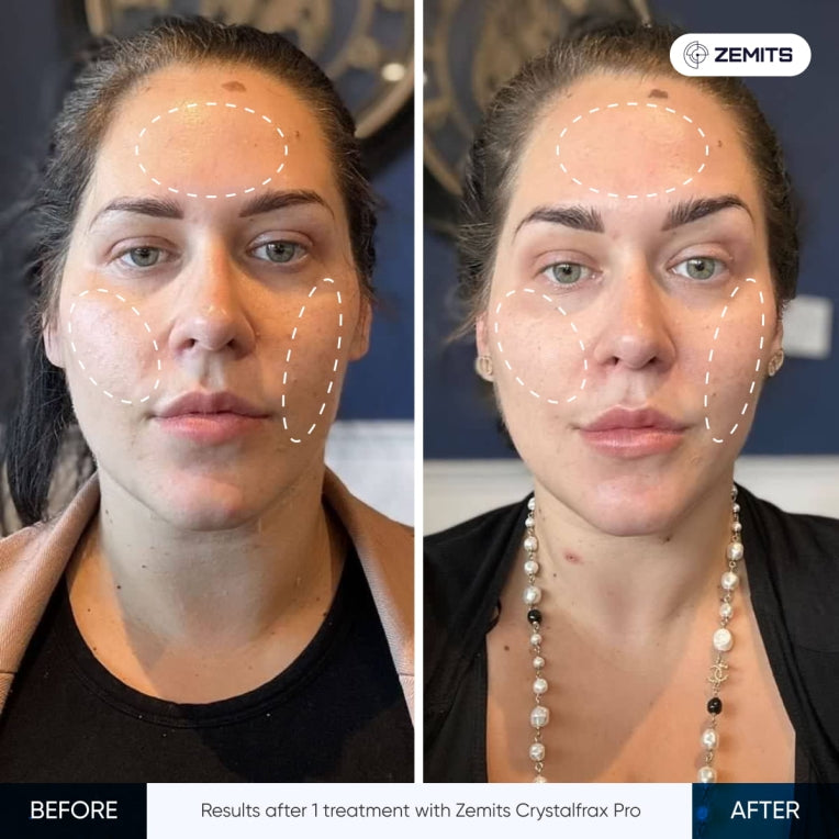 Zemits CrystalFrax PRO Système RF Fractionnel Non-Invasif