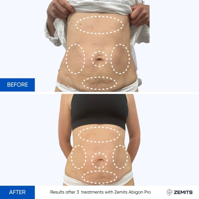 Zemits Abigon Pro Système Ultime de Remodelage Corporel et d'Amincissement
